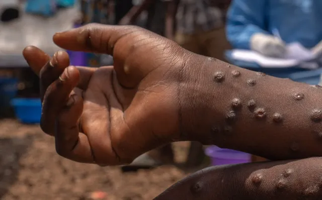 Ghana Records 18 New Mpox Cases, Total Reaches 346